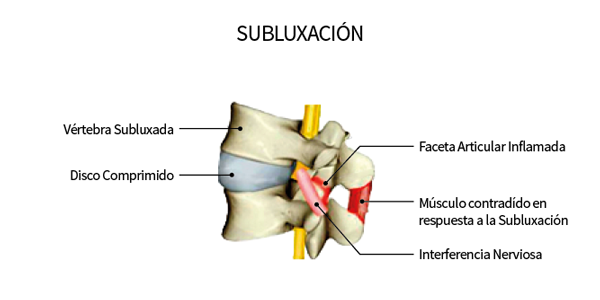 subluxacion vertical quiropráctico medellin Atlas